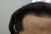 告别“蒲公英脑袋”：2026年植发技术亲民报告书，一次看懂门道与选择